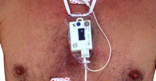 monitoring du rythme cardiaque de longue durée (holter)